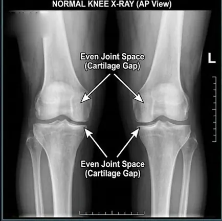 Normal knee X-ray with an even joint space