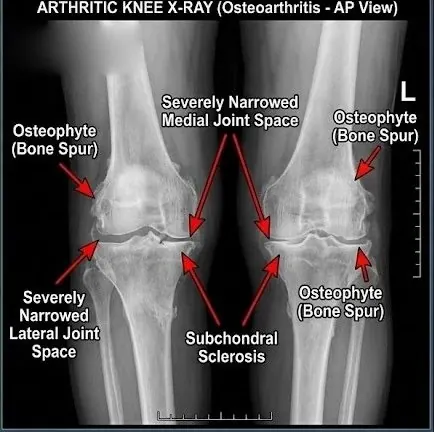 Arthritic knee X-ray with narrowed joint space and bone spurs